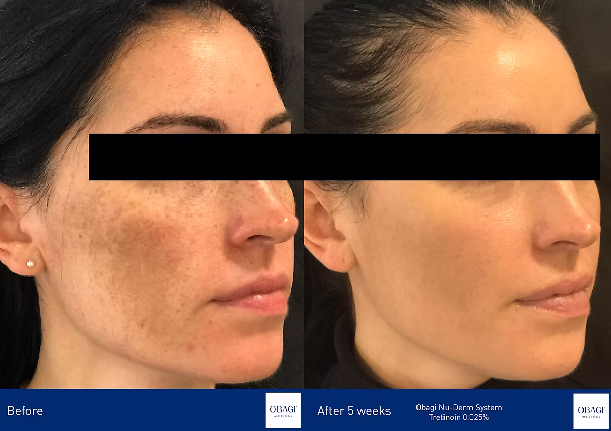 Obagi Nu Derm system