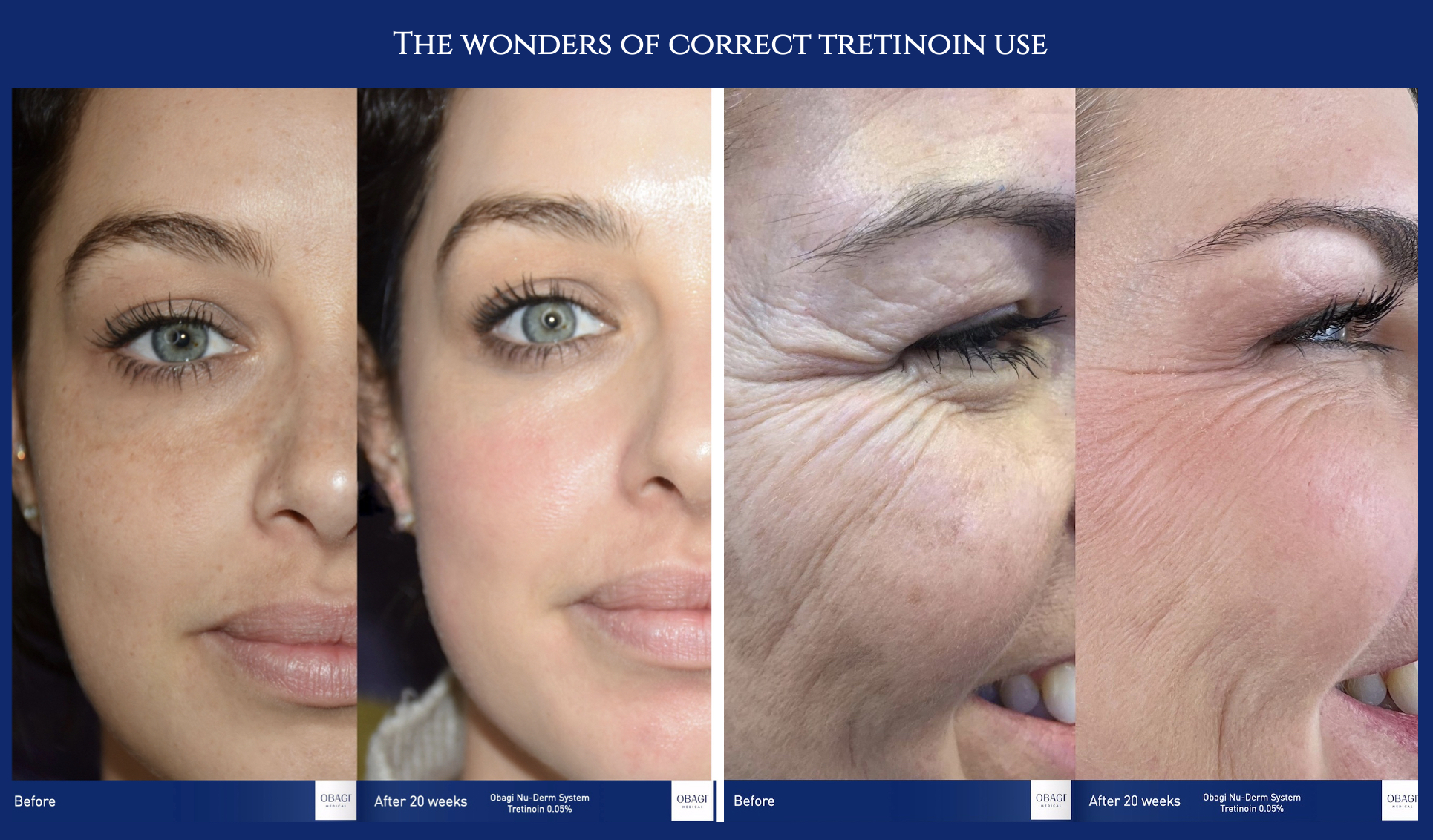 The wonders of correct tretinoin use